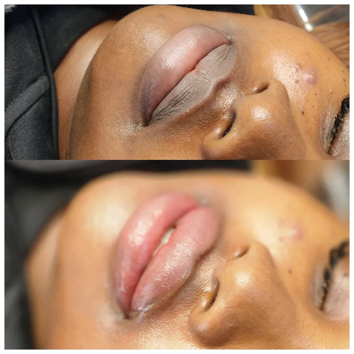 Before and after: Dark lip neutralisation
