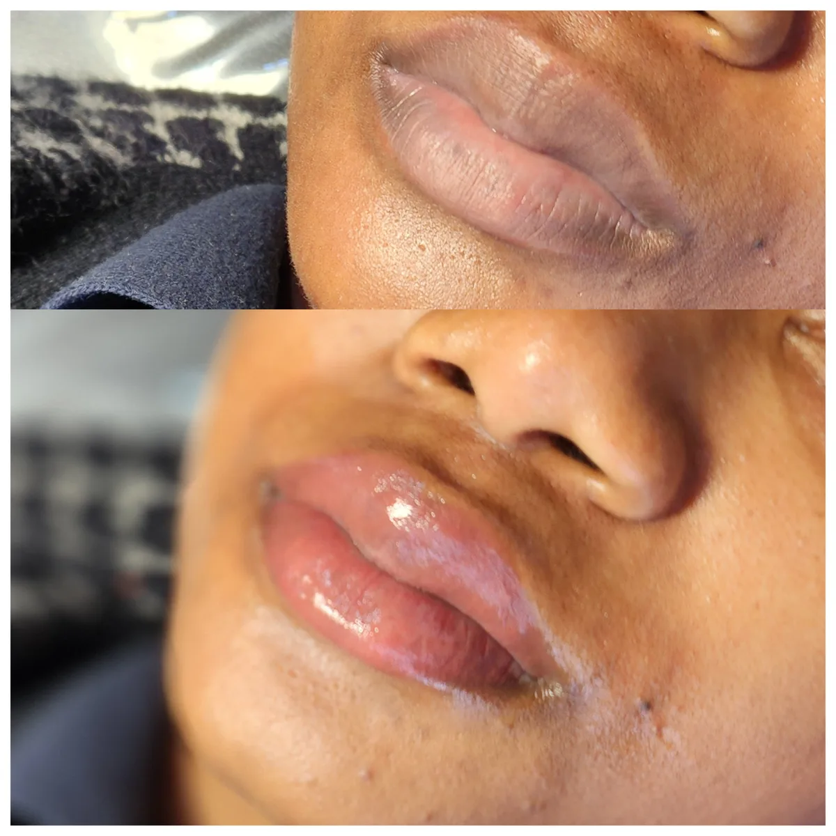 Before and after: Dark lip neutralisation