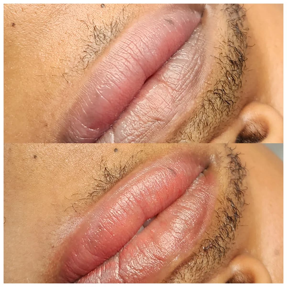 Before and after: Dark lip neutralisation