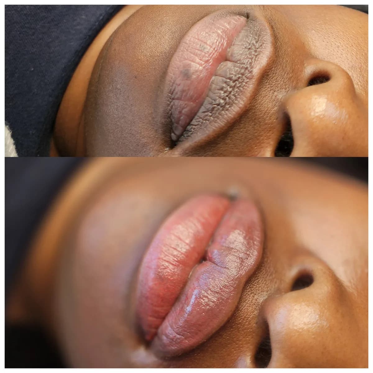 Before and after: Dark lip neutralisation