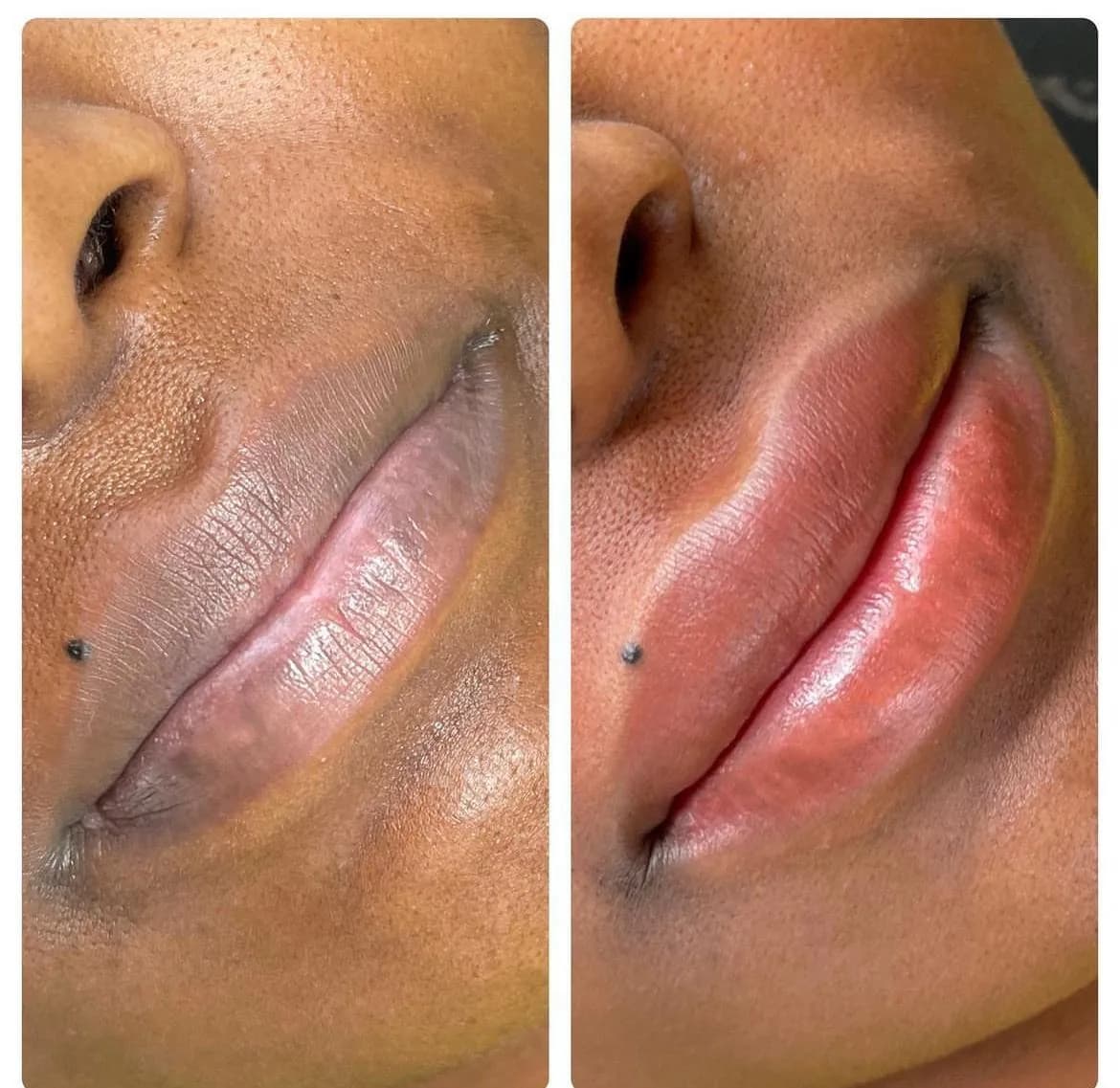 Before and after: Dark lip neutralisation