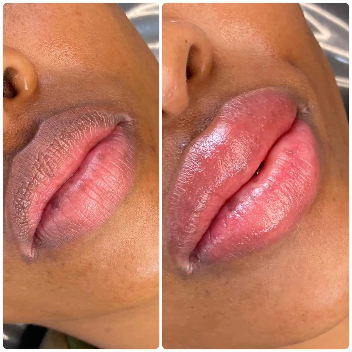 Before and after: Dark lip neutralisation