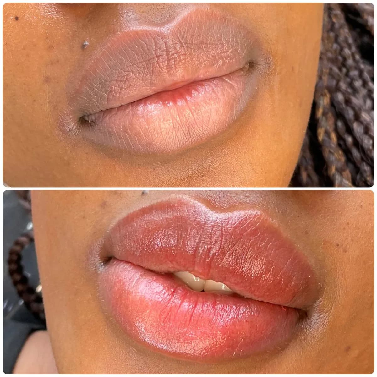 Before and after: Dark lip neutralisation
